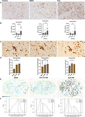 The link between SARS-CoV-2 related microglial reactivity and astrocyte pathology in the inferior olivary nucleus